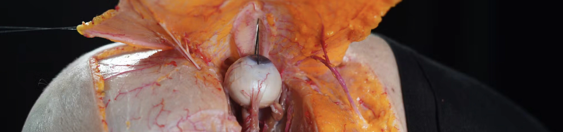 Periorbital Treatments: Palpebromalar grooves with Cannula (Inferior Approach)