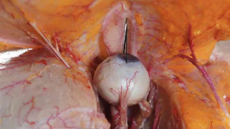 Periorbital Treatments: Palpebromalar grooves with Cannula (Inferior Approach)