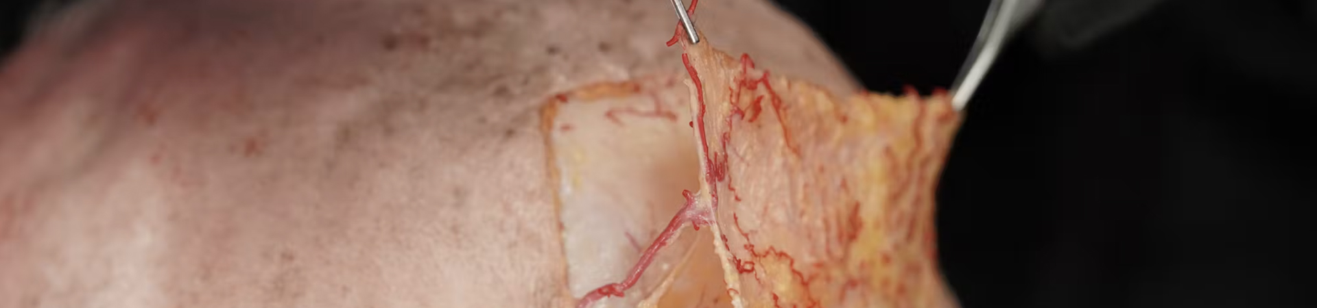 Periorbital Treatments: The A-Frame Deformity