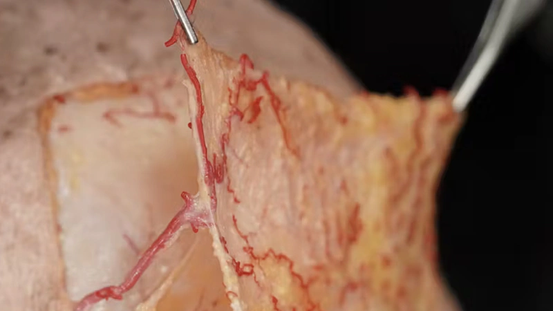 Periorbital Treatments: The A-Frame Deformity