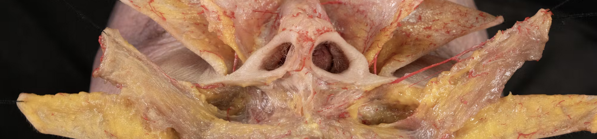 Nose Treatments: Correction of Alar Retraction