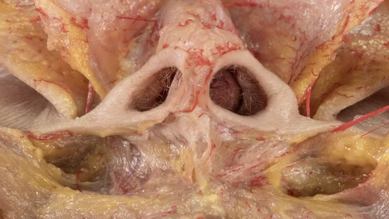 Nose Treatments: Correction of Alar Retraction