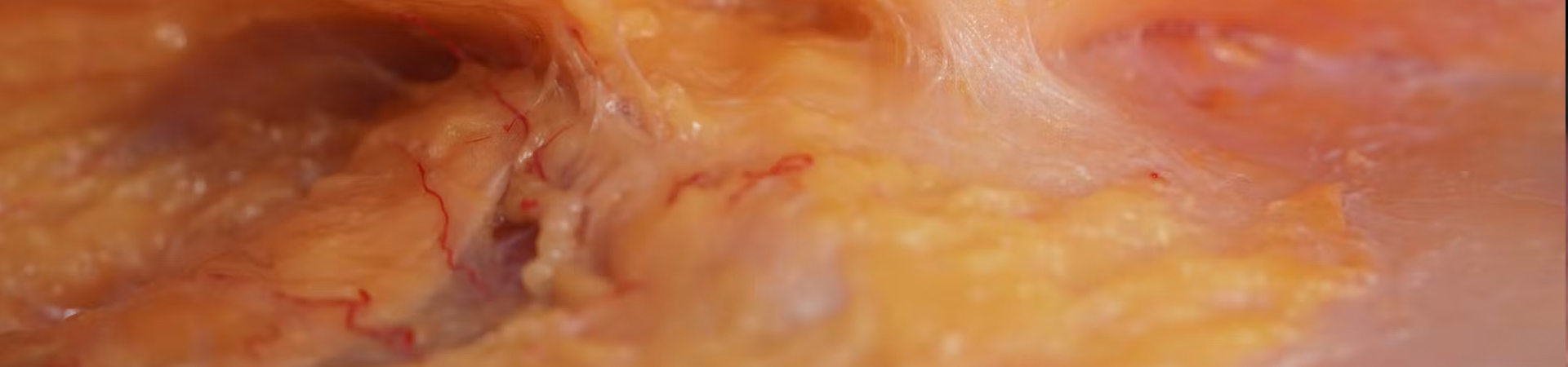 Deep Zygomatic Arch Enhancement with Cannula