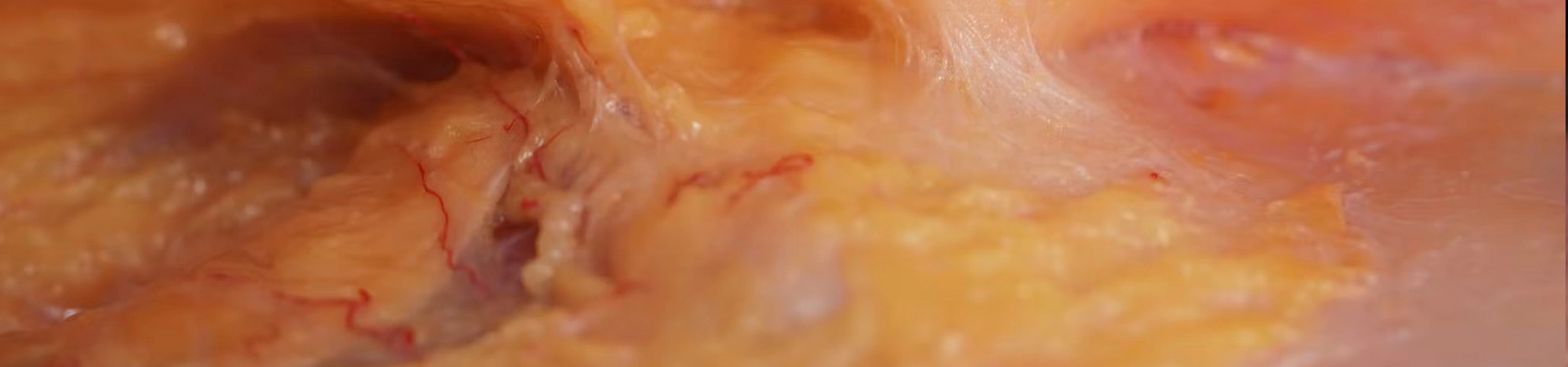 Deep Zygomatic Arch Enhancement with Cannula