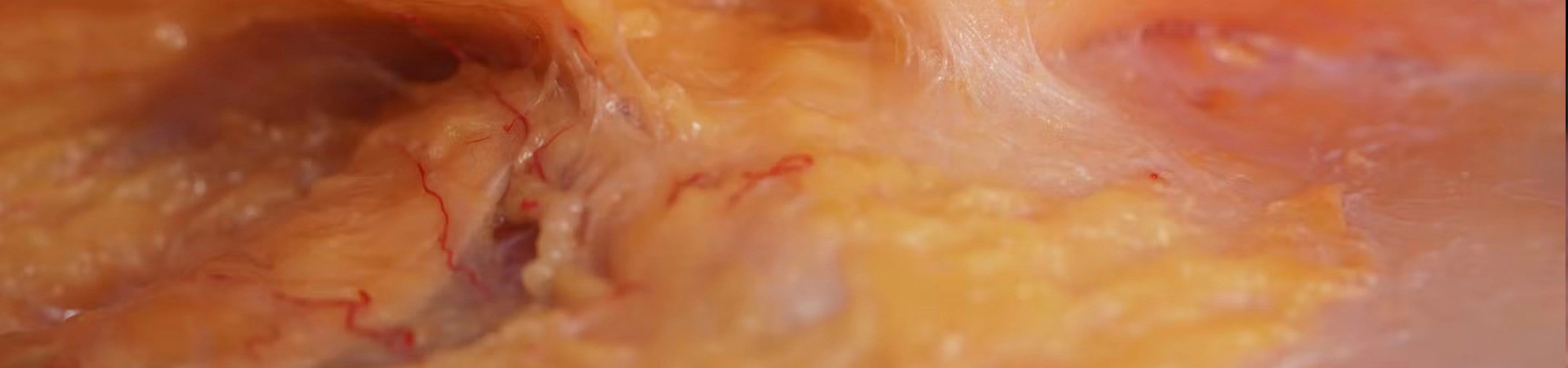 Deep Zygomatic Arch Enhancement with Cannula