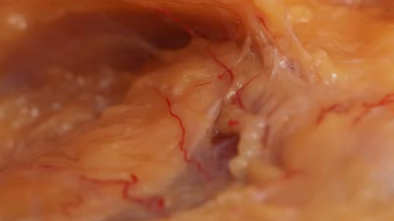 Deep Zygomatic Arch Enhancement with Cannula
