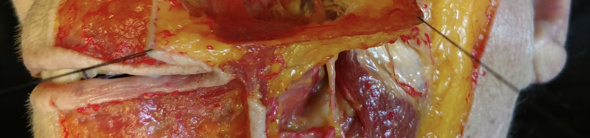 Neuromodulator Treatments: Gummy Smile