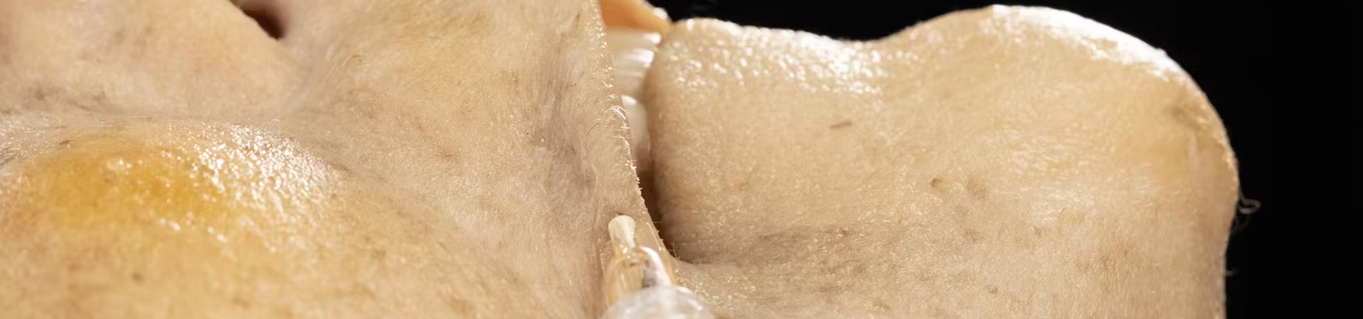Lip Volumization: Combined Treatments with Needle and Cannula