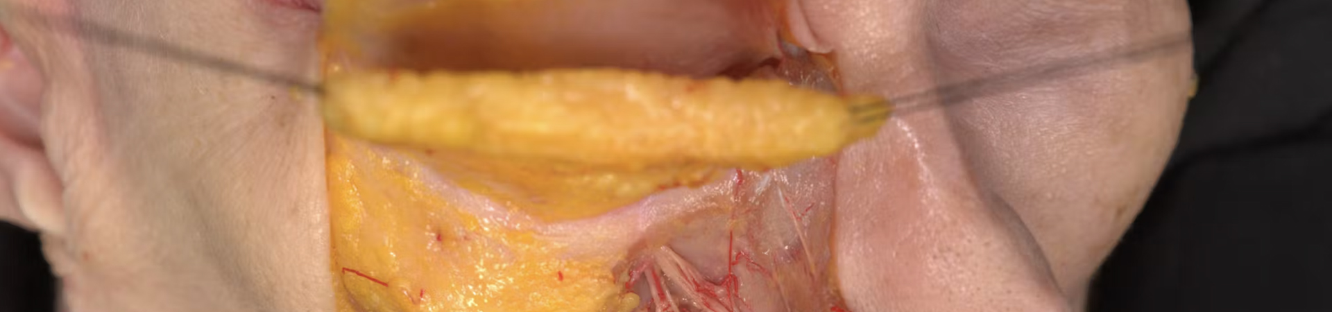 Basic Anatomy for Neuromodulator Treatments: LLSAN Muscle