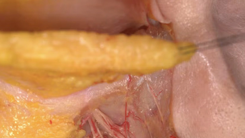 Basic Anatomy for Neuromodulator Treatments: LLSAN Muscle