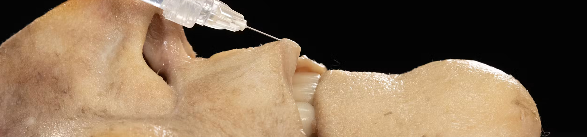 Lip Volumizing with Needle: Vertical Technique