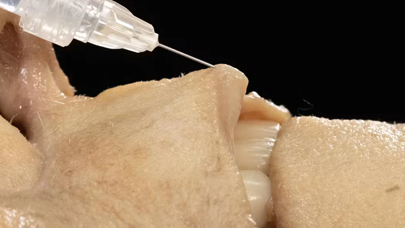 Lip Volumizing with Needle: Vertical Technique