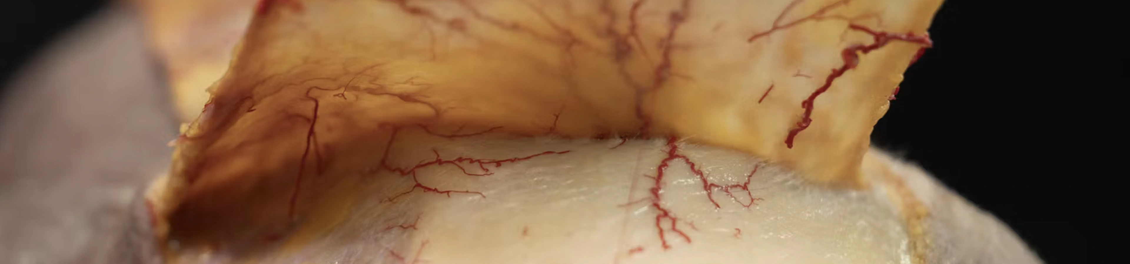 Periorbital Treatments: Lateral Canthal Furrows with Needle and Cannula
