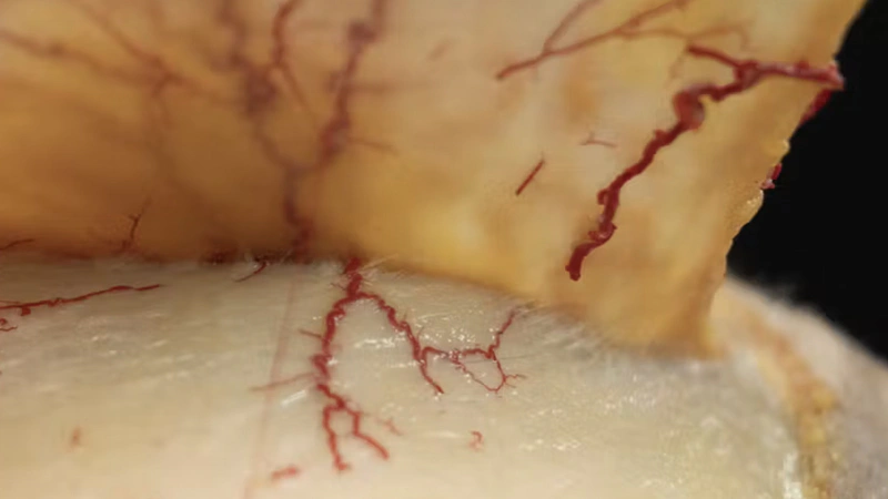 Periorbital Treatments: Lateral Canthal Furrows with Needle and Cannula