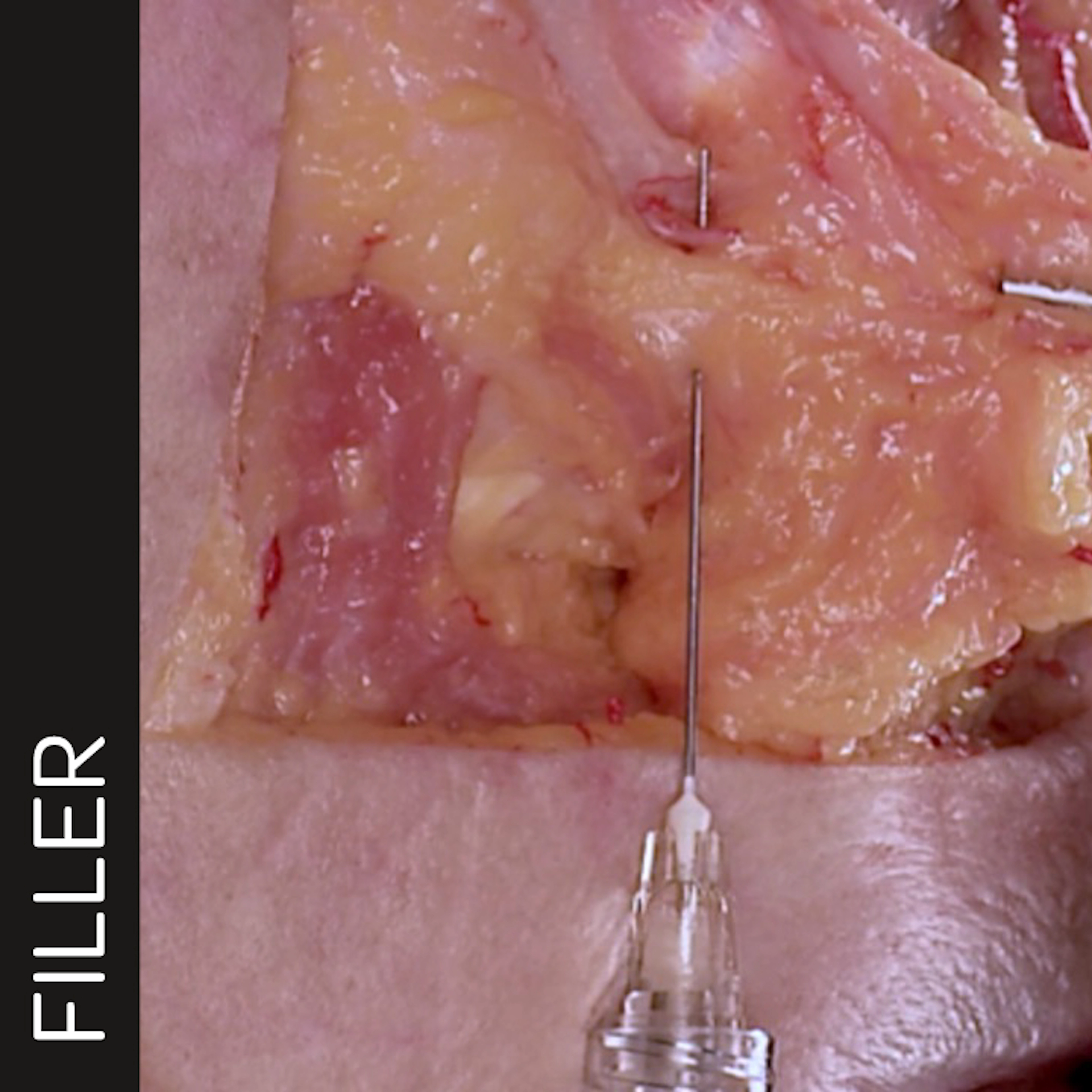 Anatomical clinical view of the lower periorbital region with elevated skin revealing underlying soft tissue and vascular-rich layers, showing cannula passage through targeted tissue planes for palpebromalar groove correction.