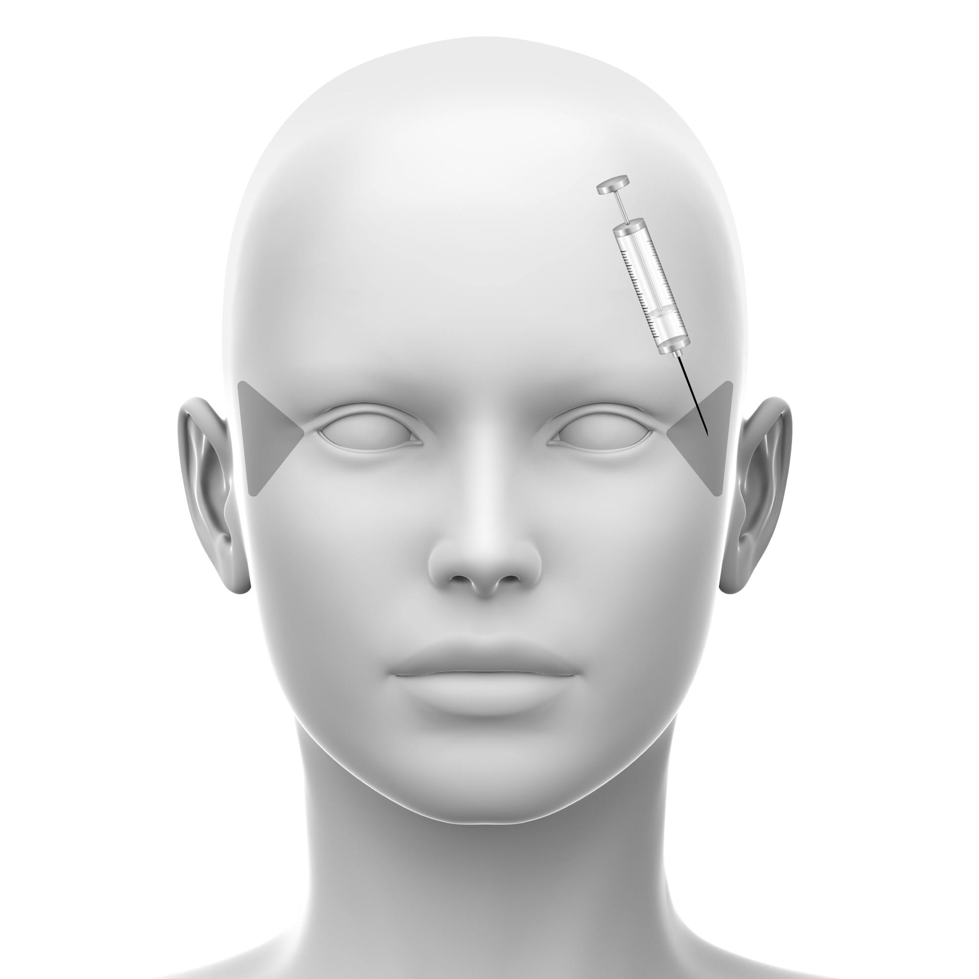 A diagrammatic image showing the lateral canthal lines