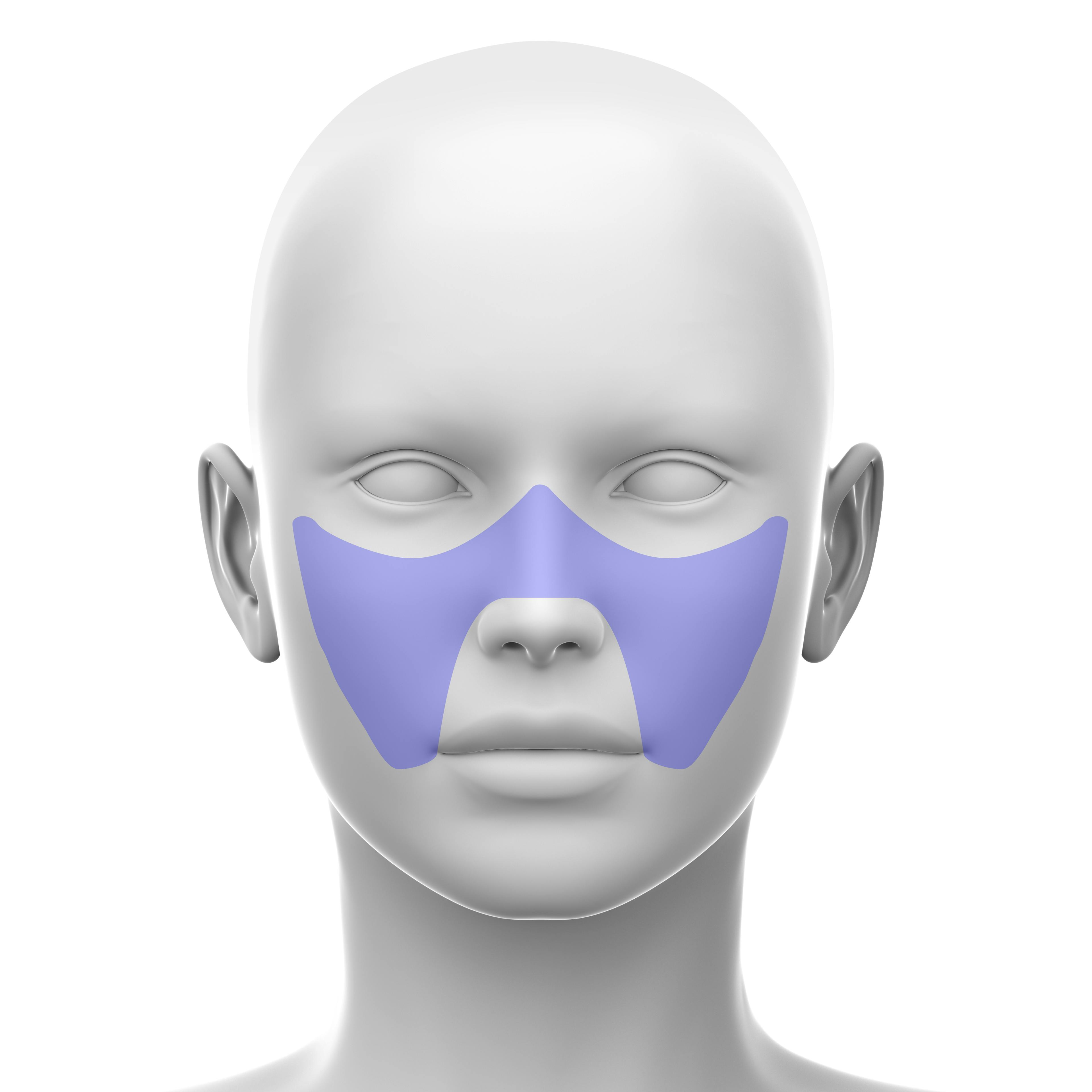 Medial Midface - soft tissue fillers