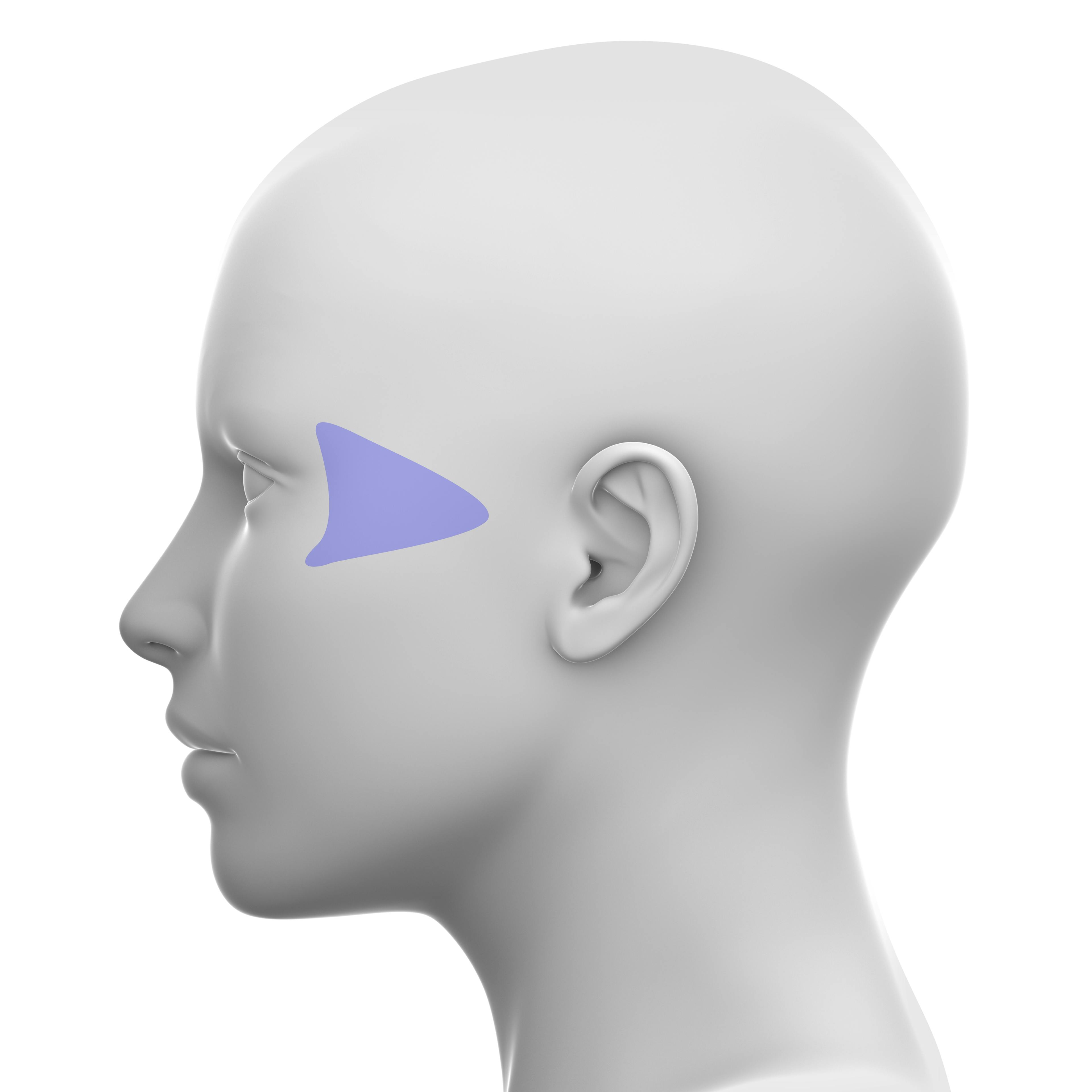 Lateral Midface - Soft tissue fillers
