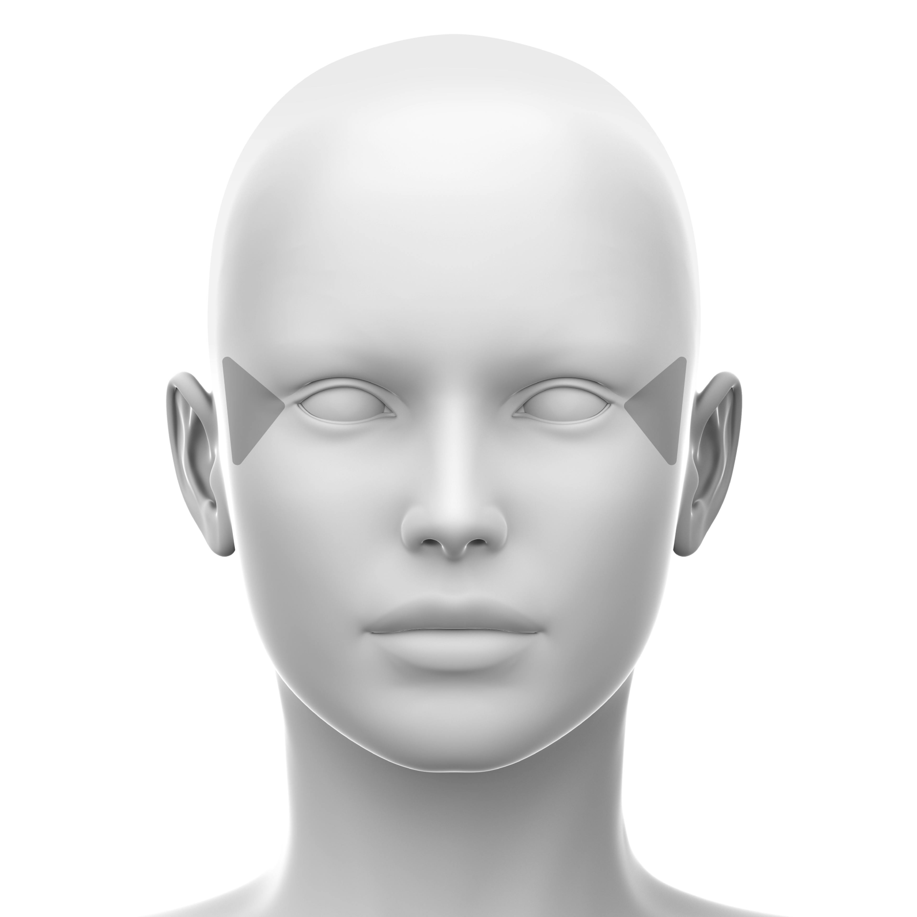 Lateral canthal lines