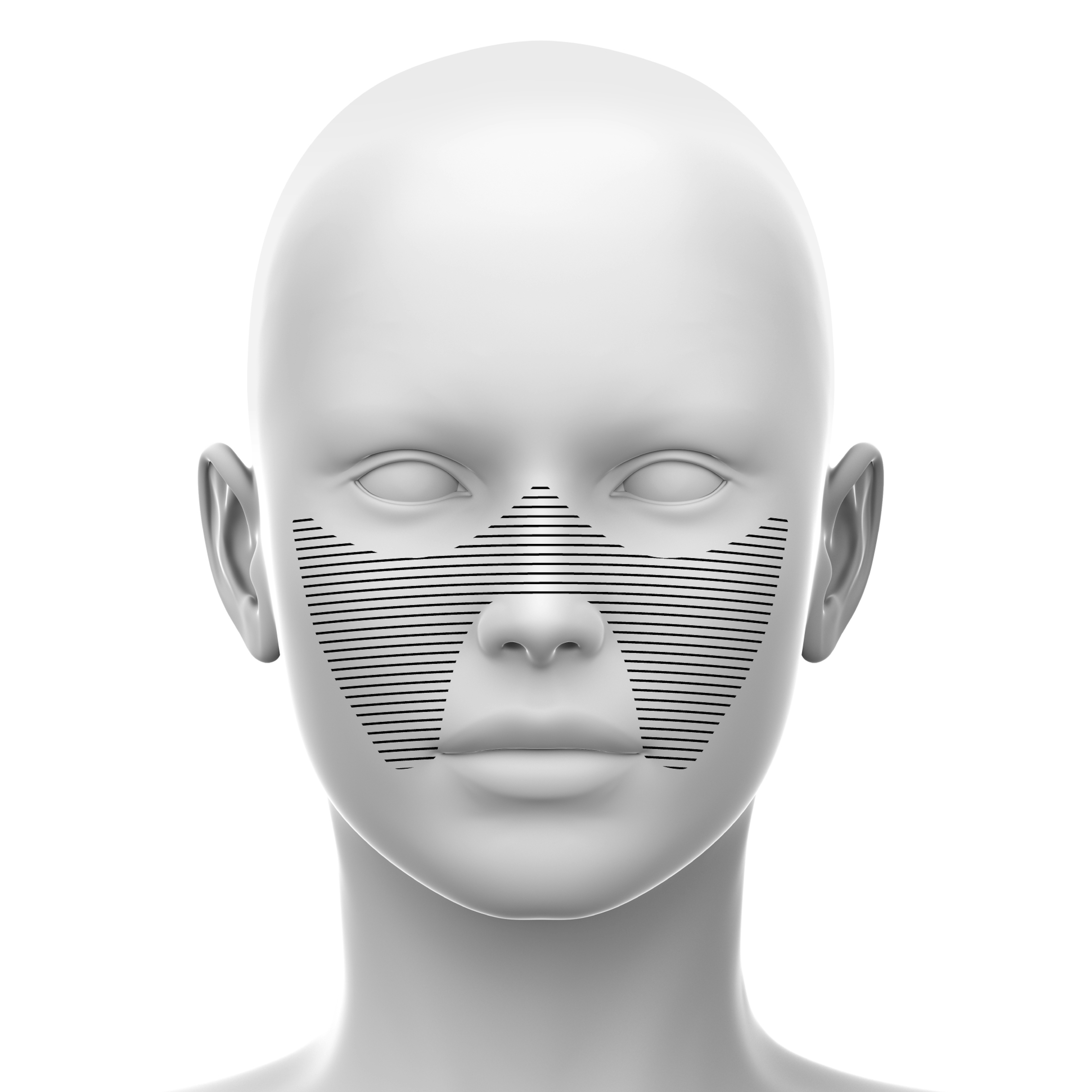 Medial Midface soft tissue fillers