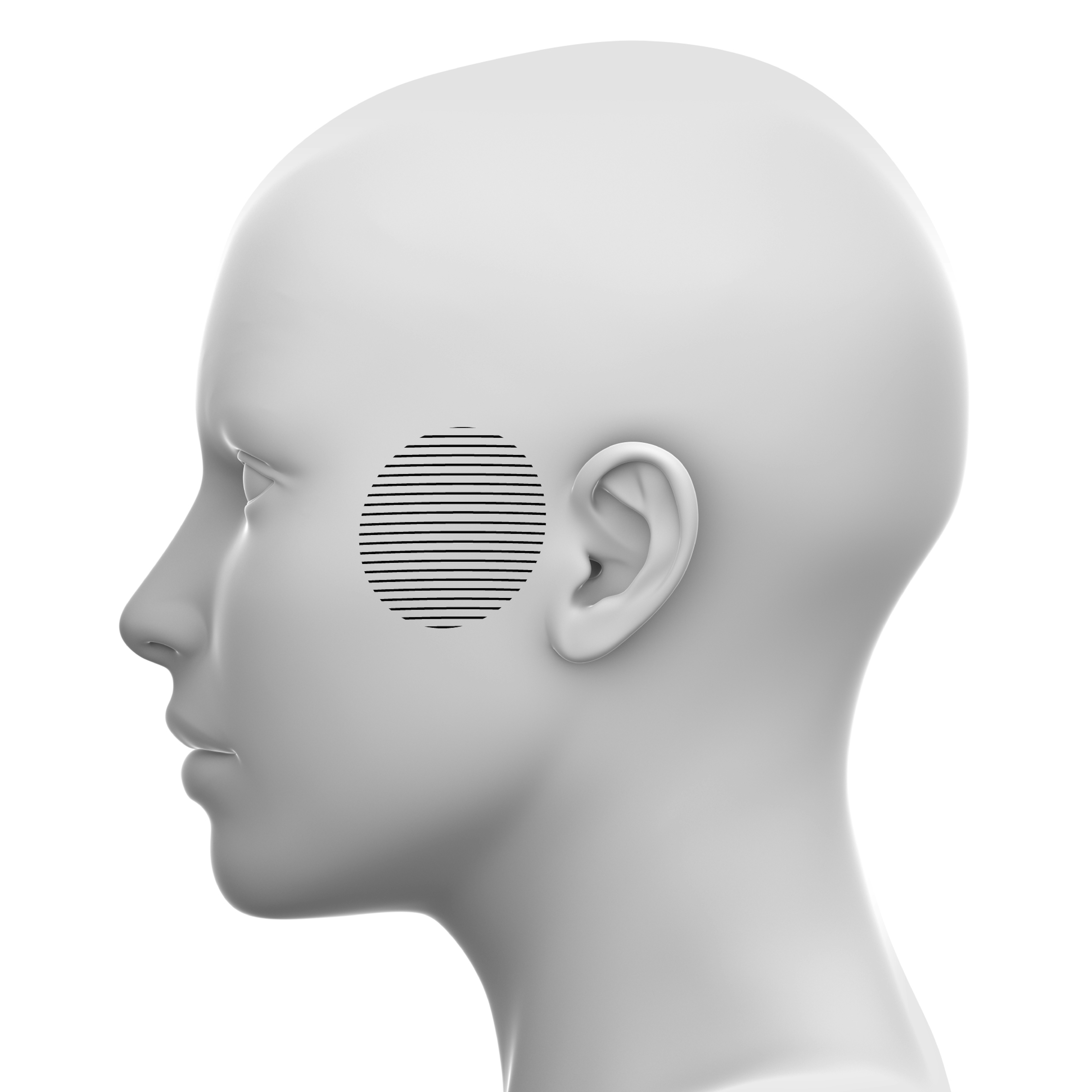 Temples Soft tissue fillers