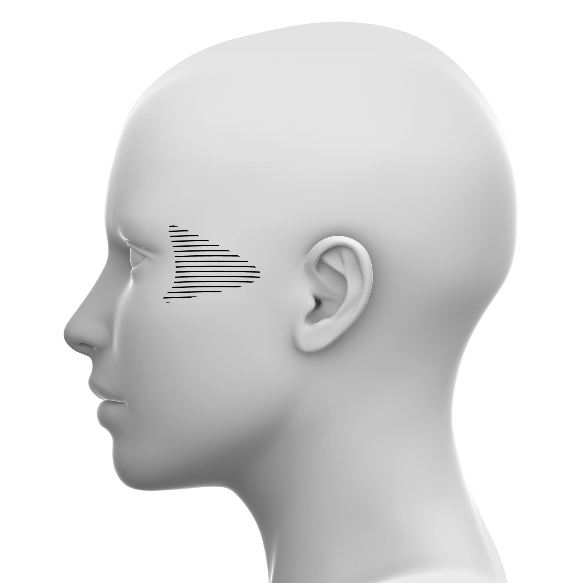 Lateral Midface Soft tissue fillers