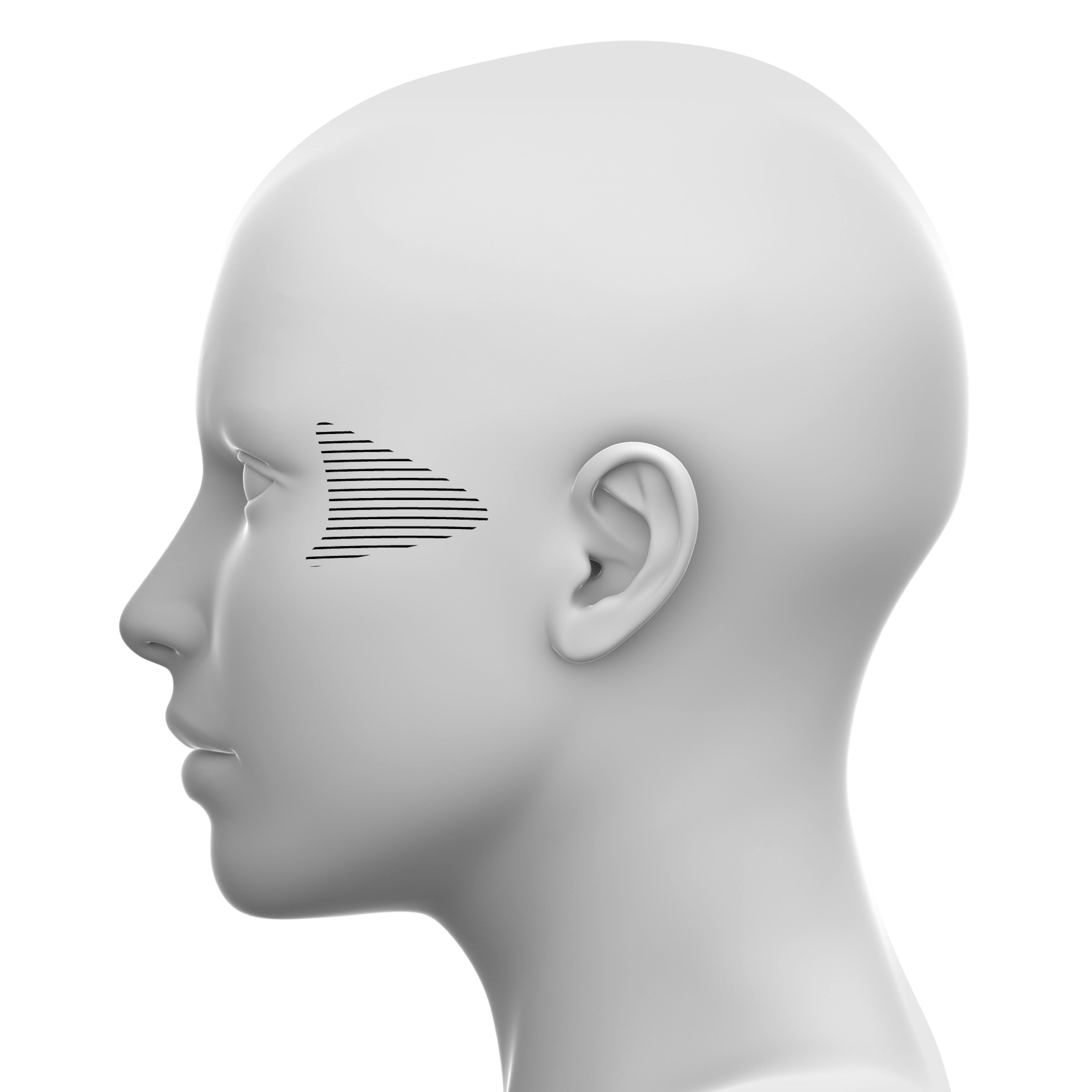 Lateral Midface Soft tissue fillers