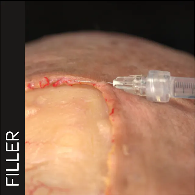 Dynamic Rhytids Treating Frontal Rhytids with Fillers: Intradermal Needle Technique ...