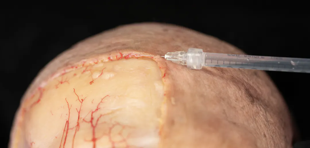 Treating Frontal Rhytids with Fillers: Intradermal Needle Technique ...