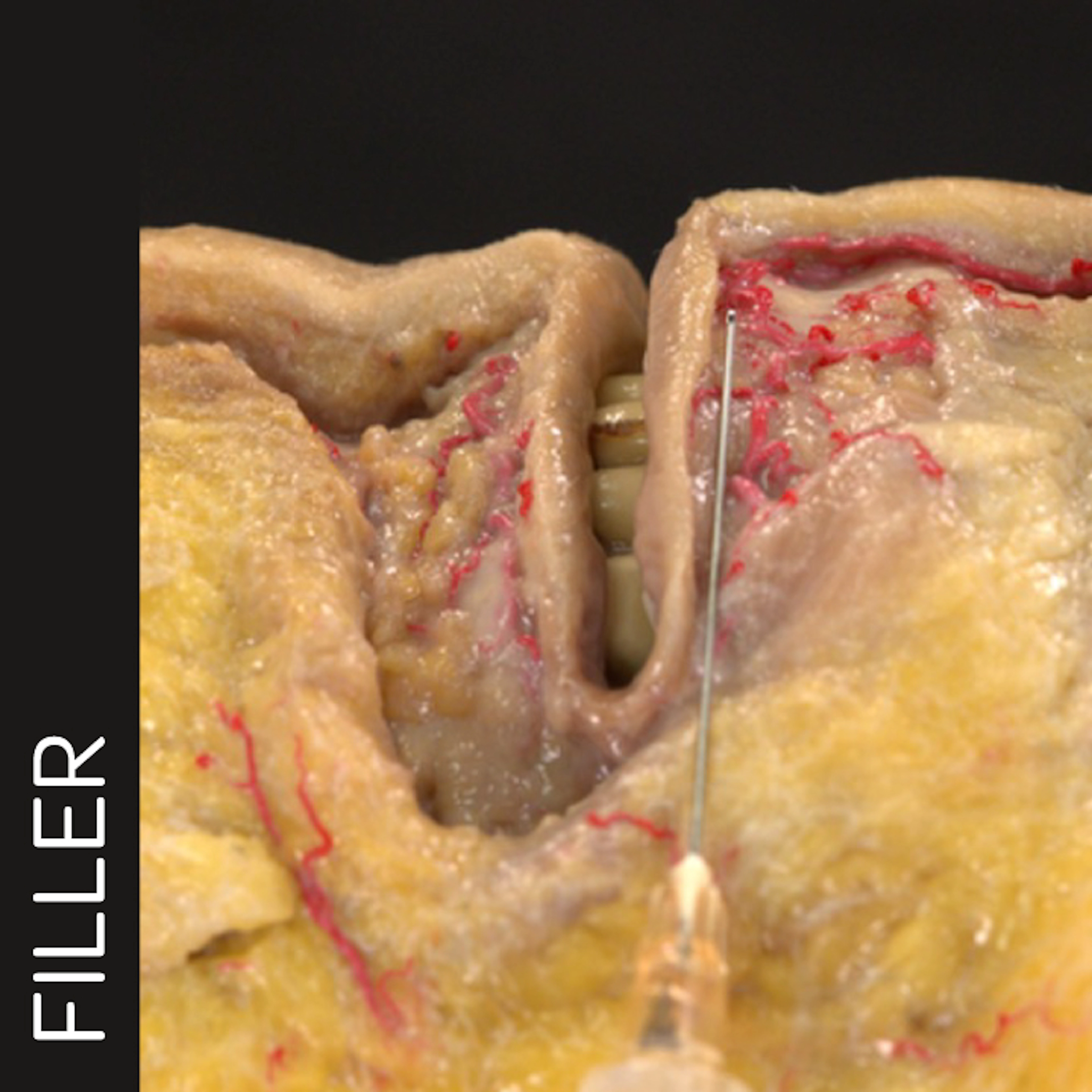 Lip Volumization with Cannula: Linear Technique
