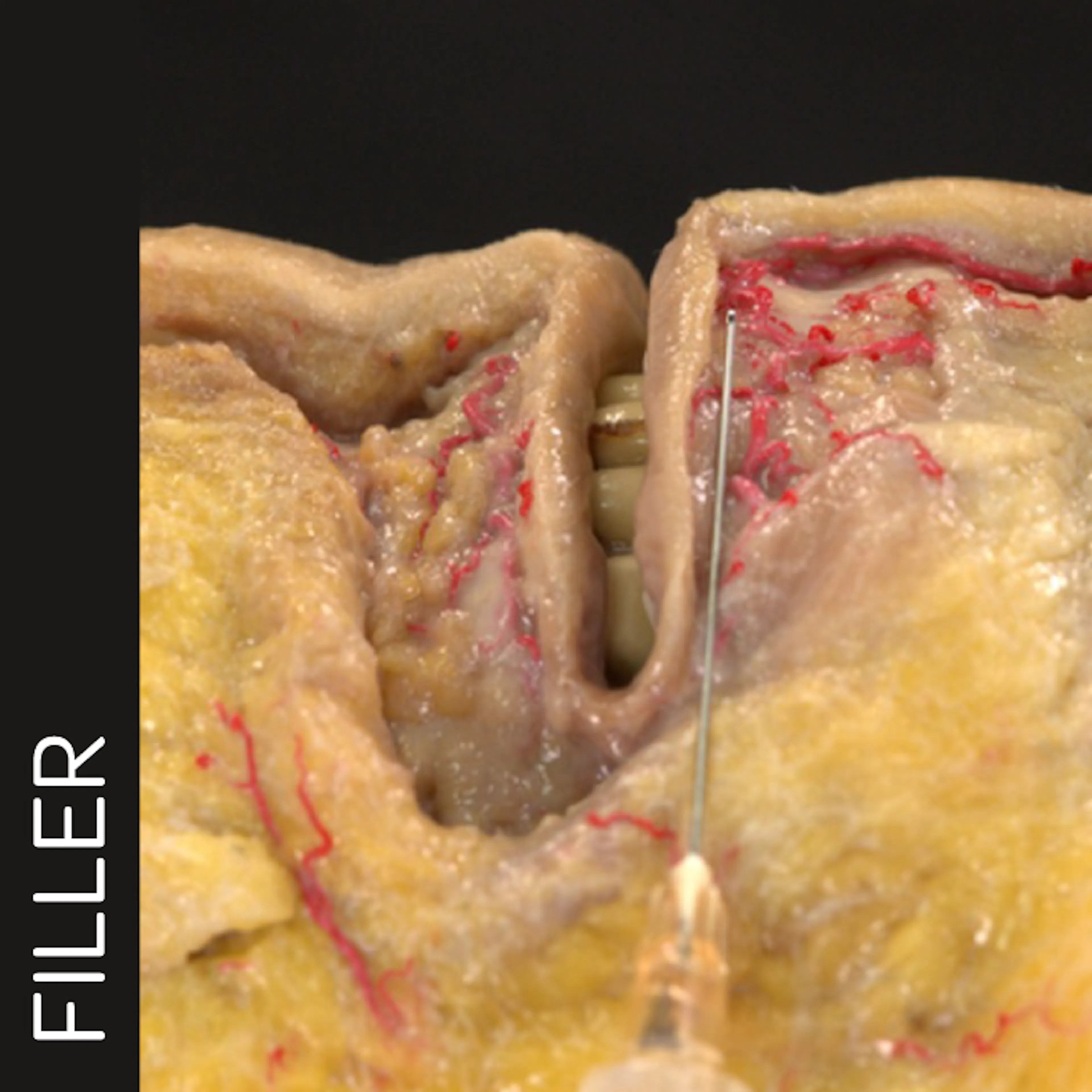 Lip Volumization with Cannula: Linear Technique