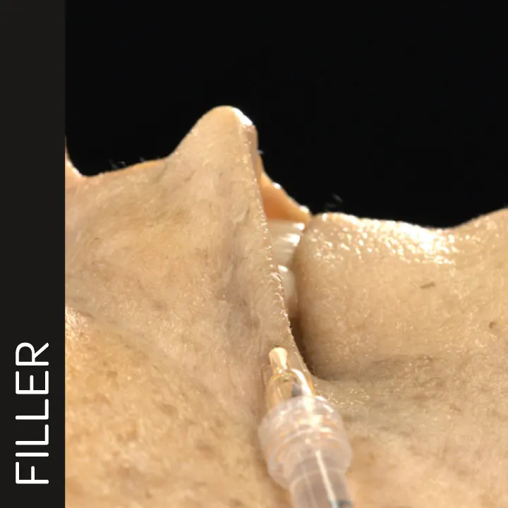 Lip Contouring with Cannula