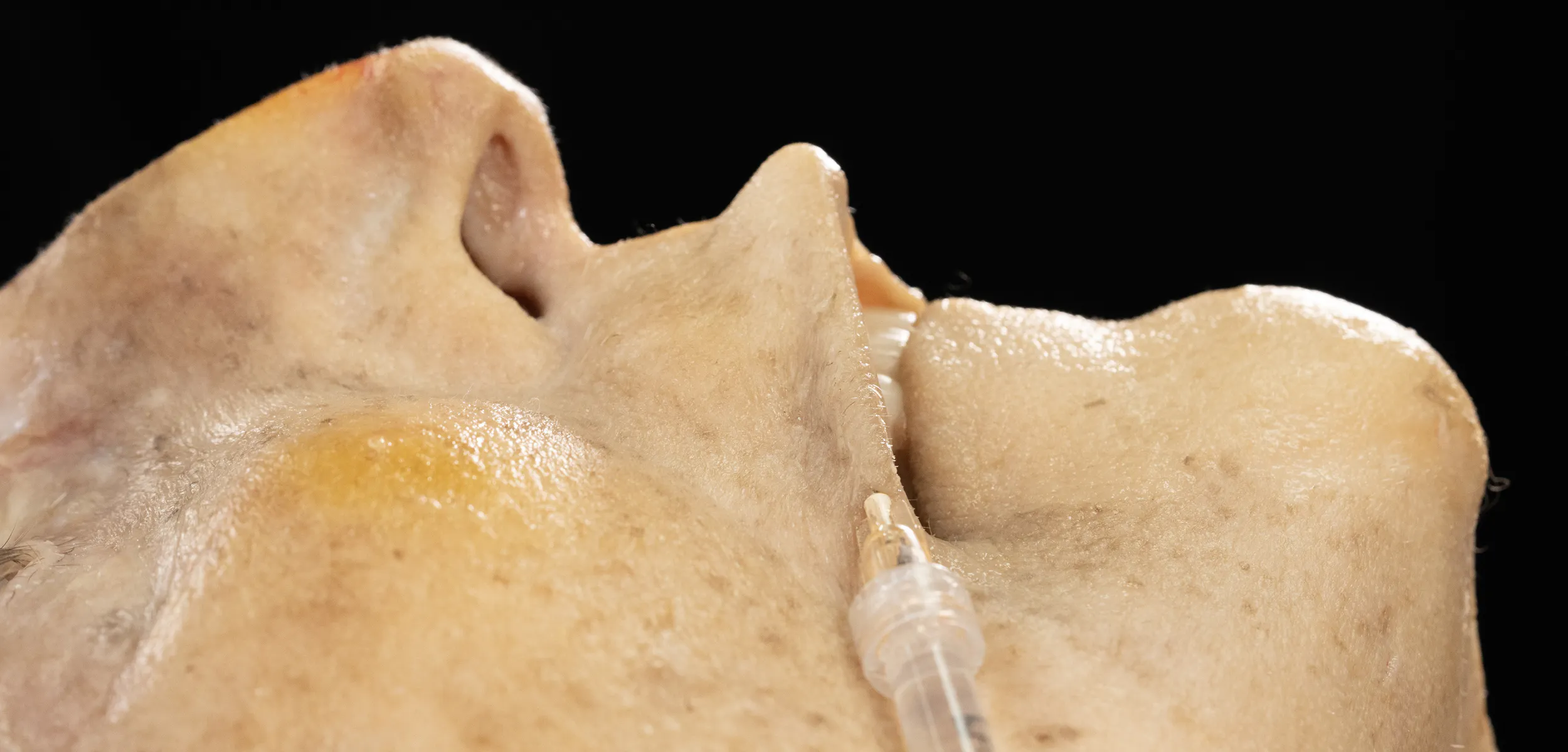 Lip contouring with cannula