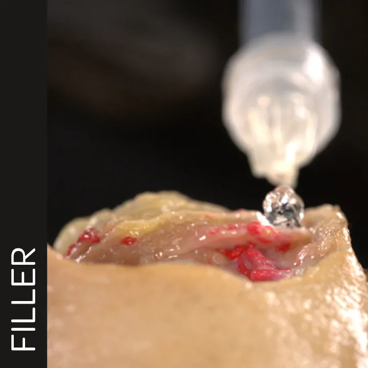 Lip Volumizing with Needle: Horizontal Technique