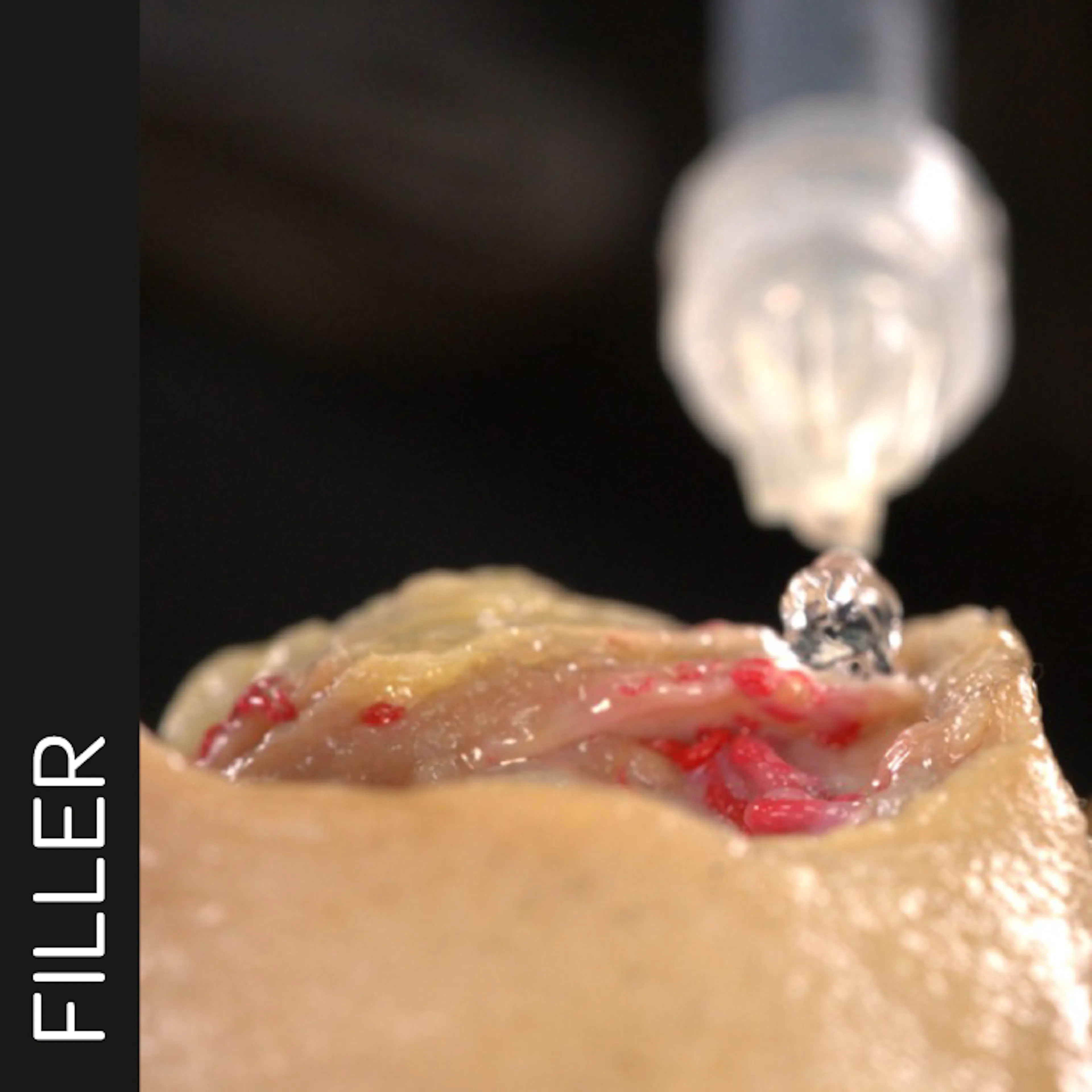 Lip Volumizing with Needle: Horizontal Technique