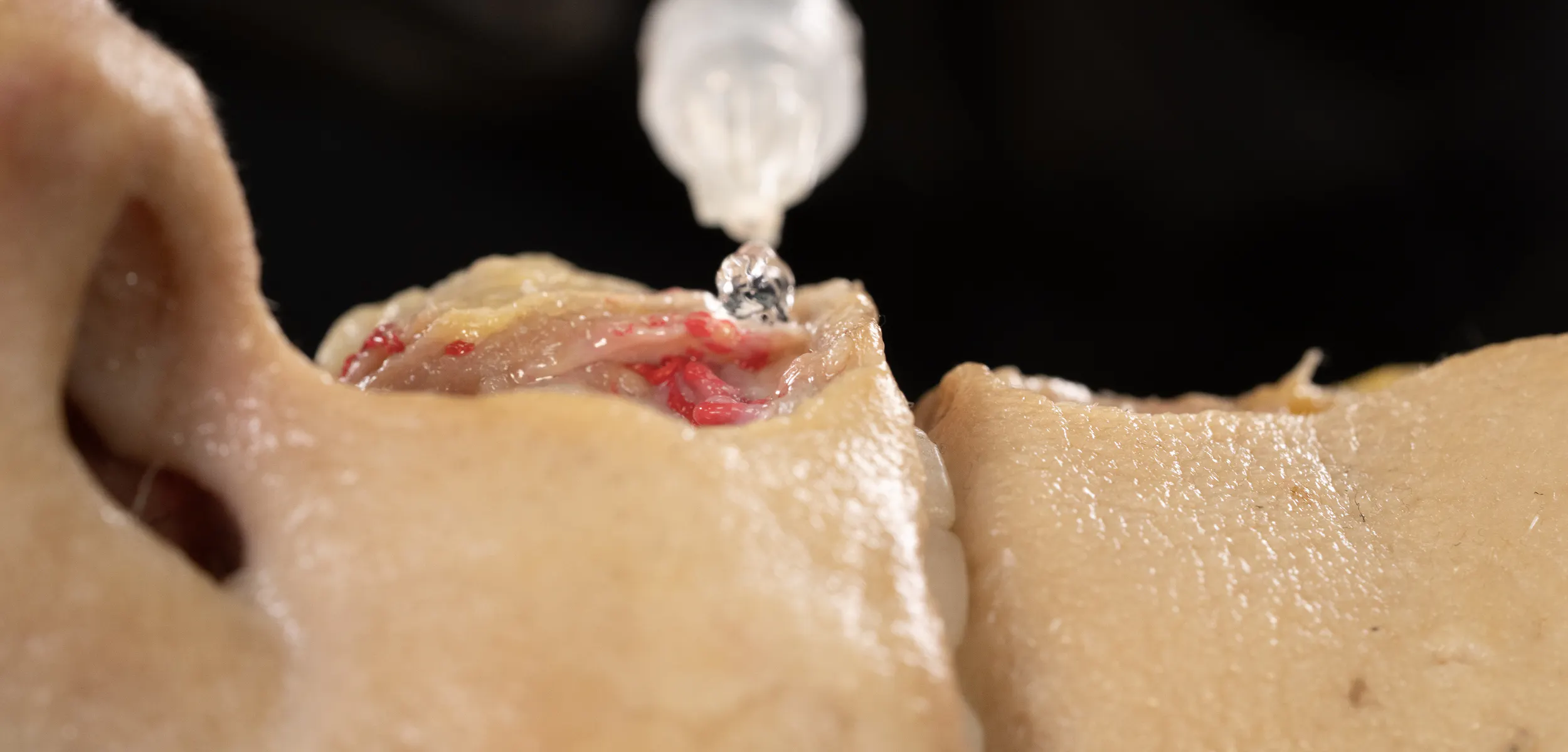 Lip Volumizing with Needle: Horizontal Technique