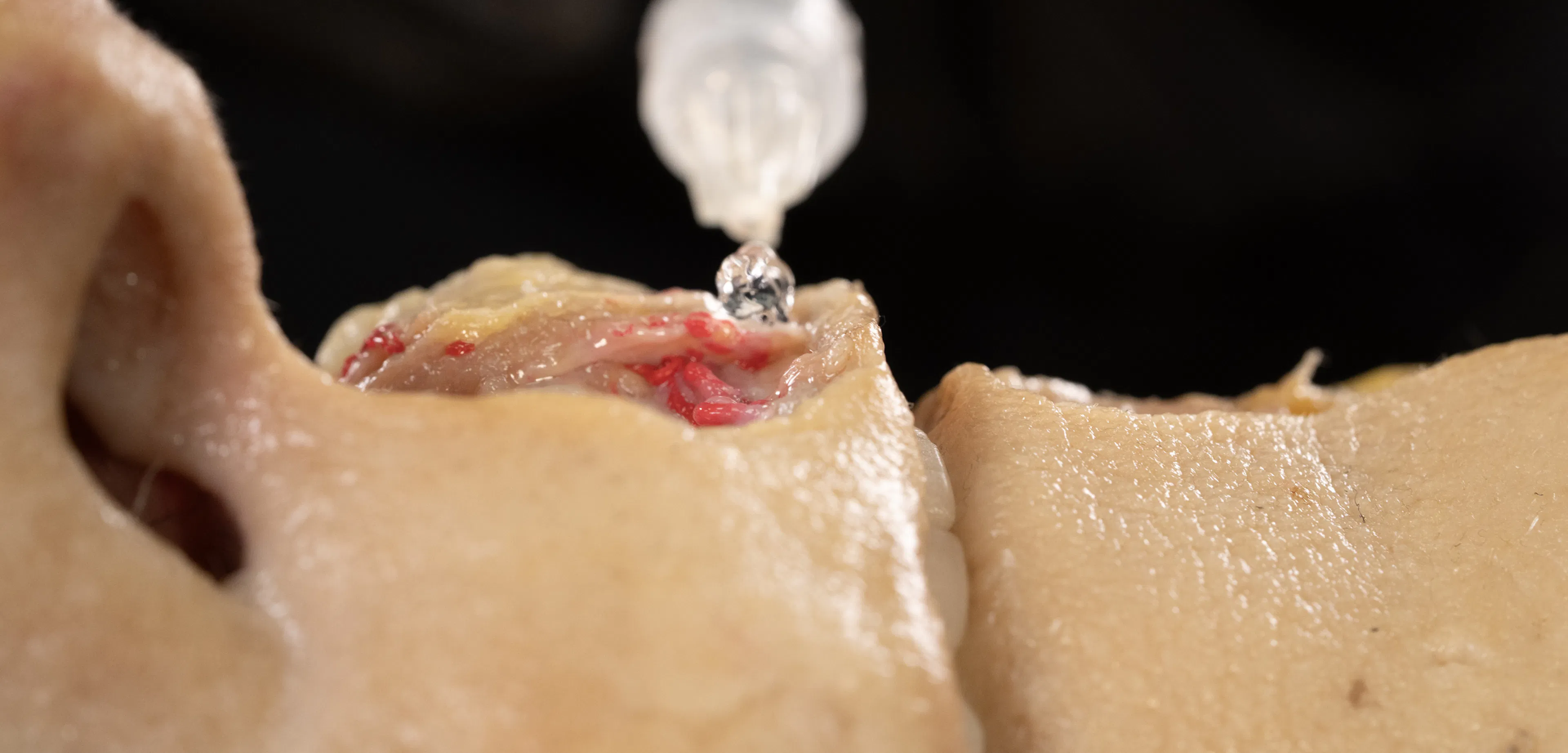 Lip Volumizing with Needle: Horizontal Technique