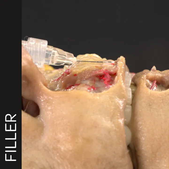 Lip Volumizing with Needle: Vertical Technique