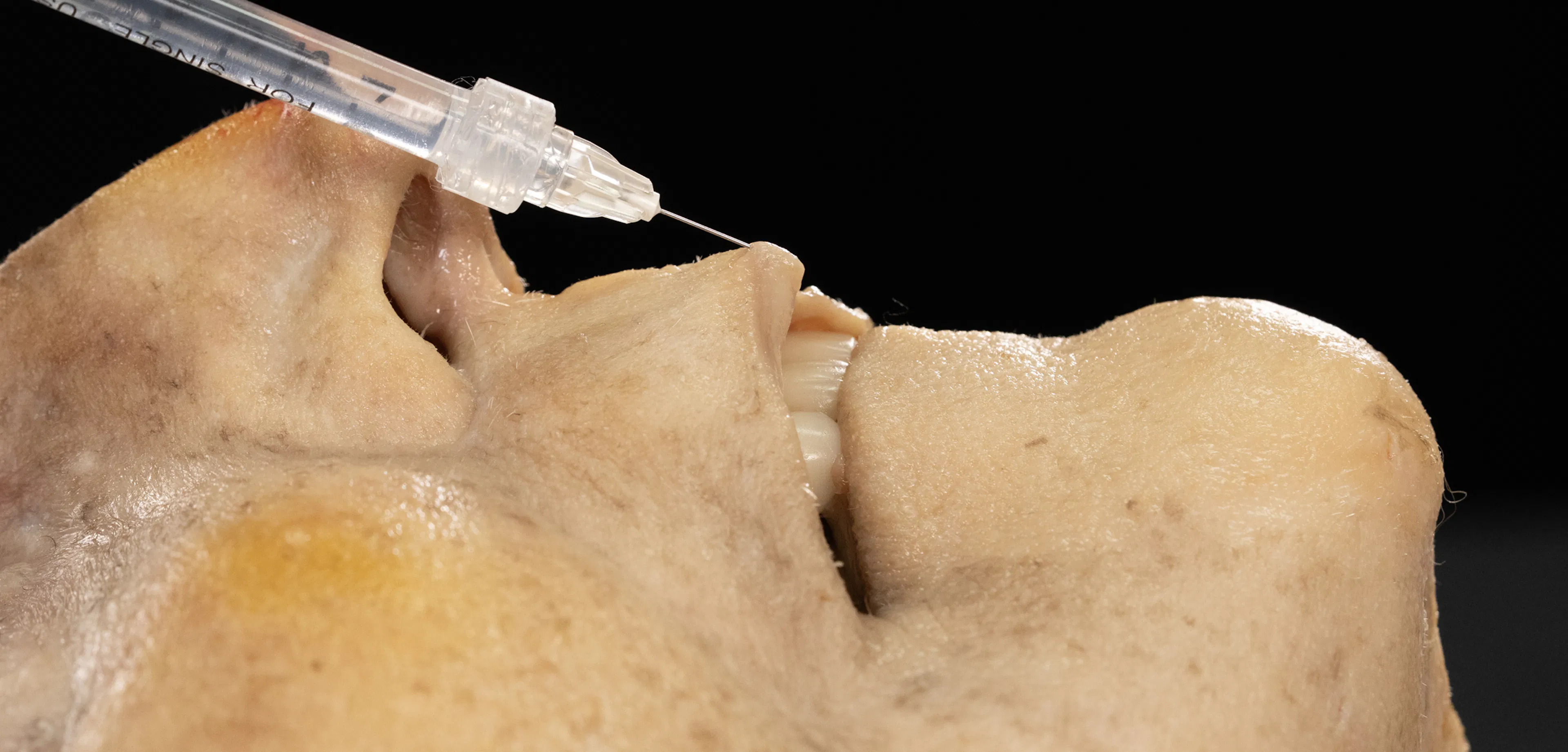 Lip Volumizing with Needle: Vertical Technique
