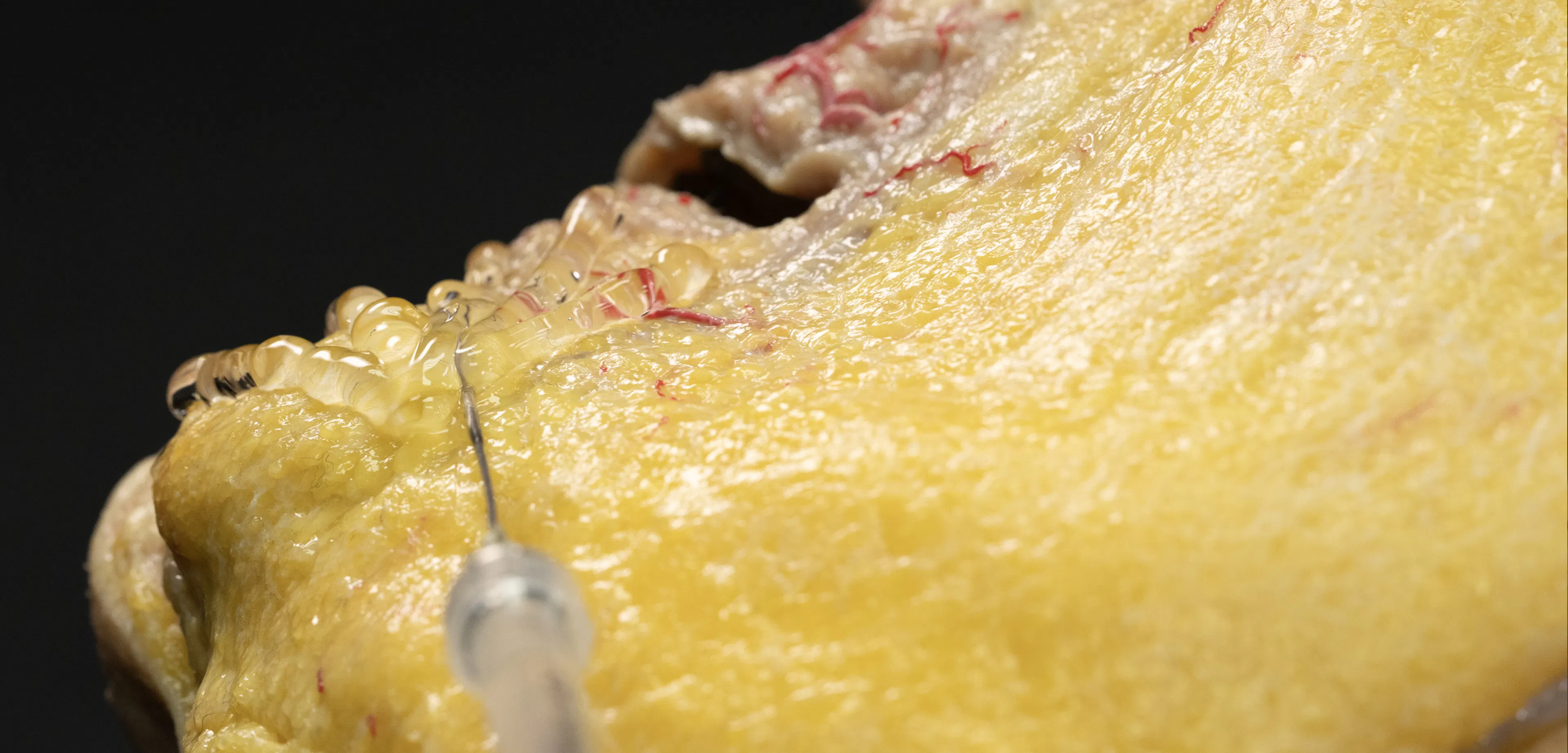 Oral Commissure Support with Cannula