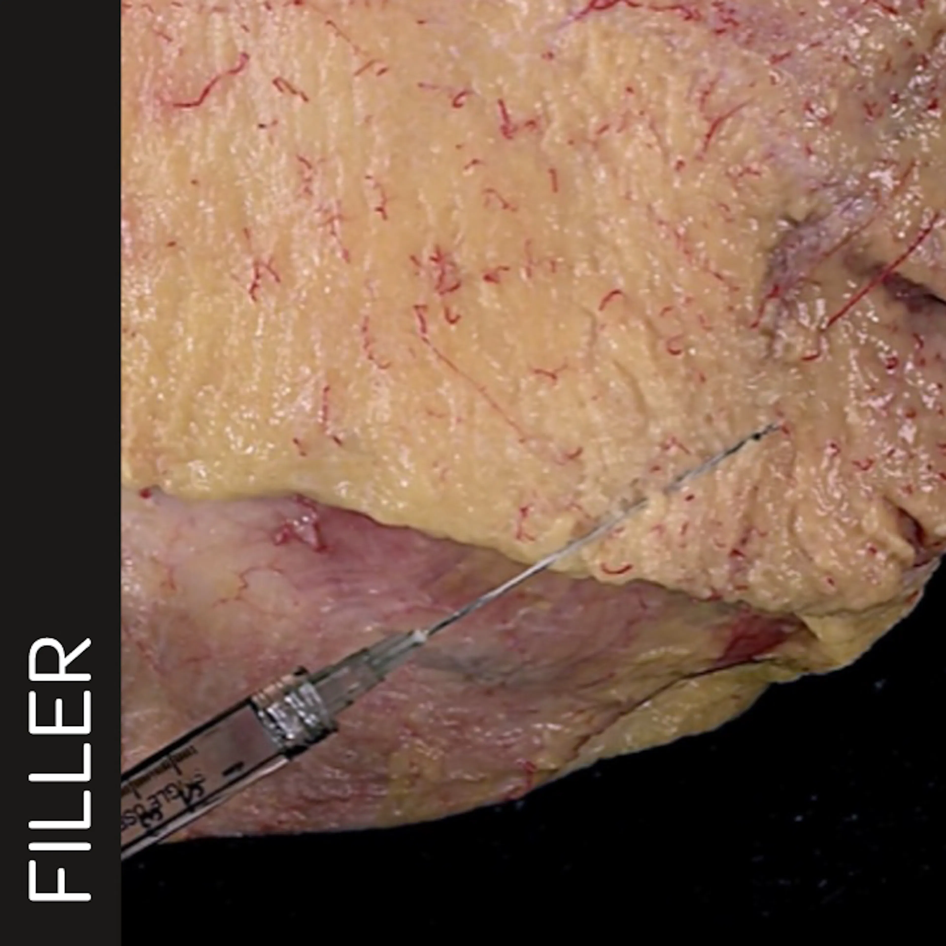 Marionette Line Treatment with Cannula