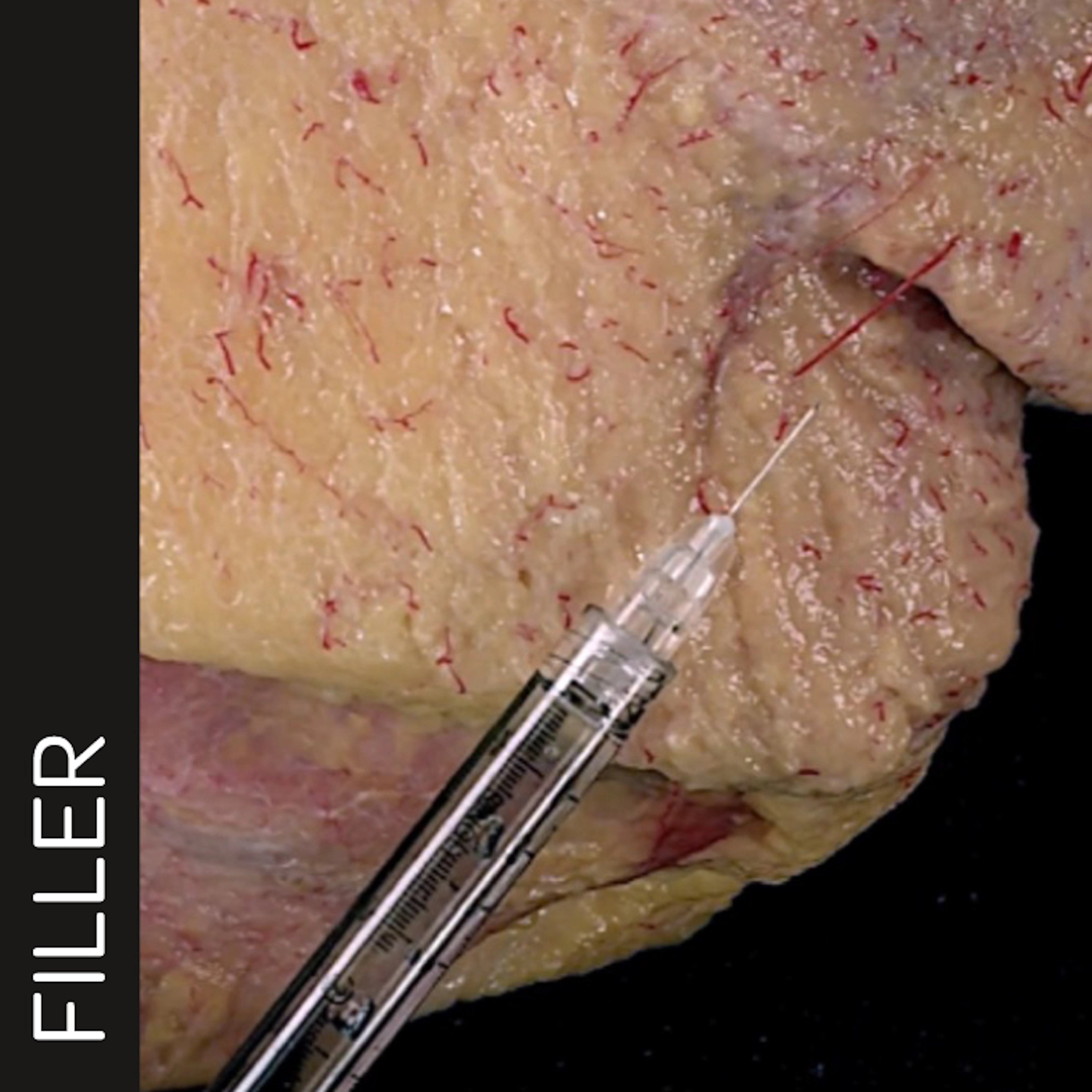 Marionette Line Treatment with Needle