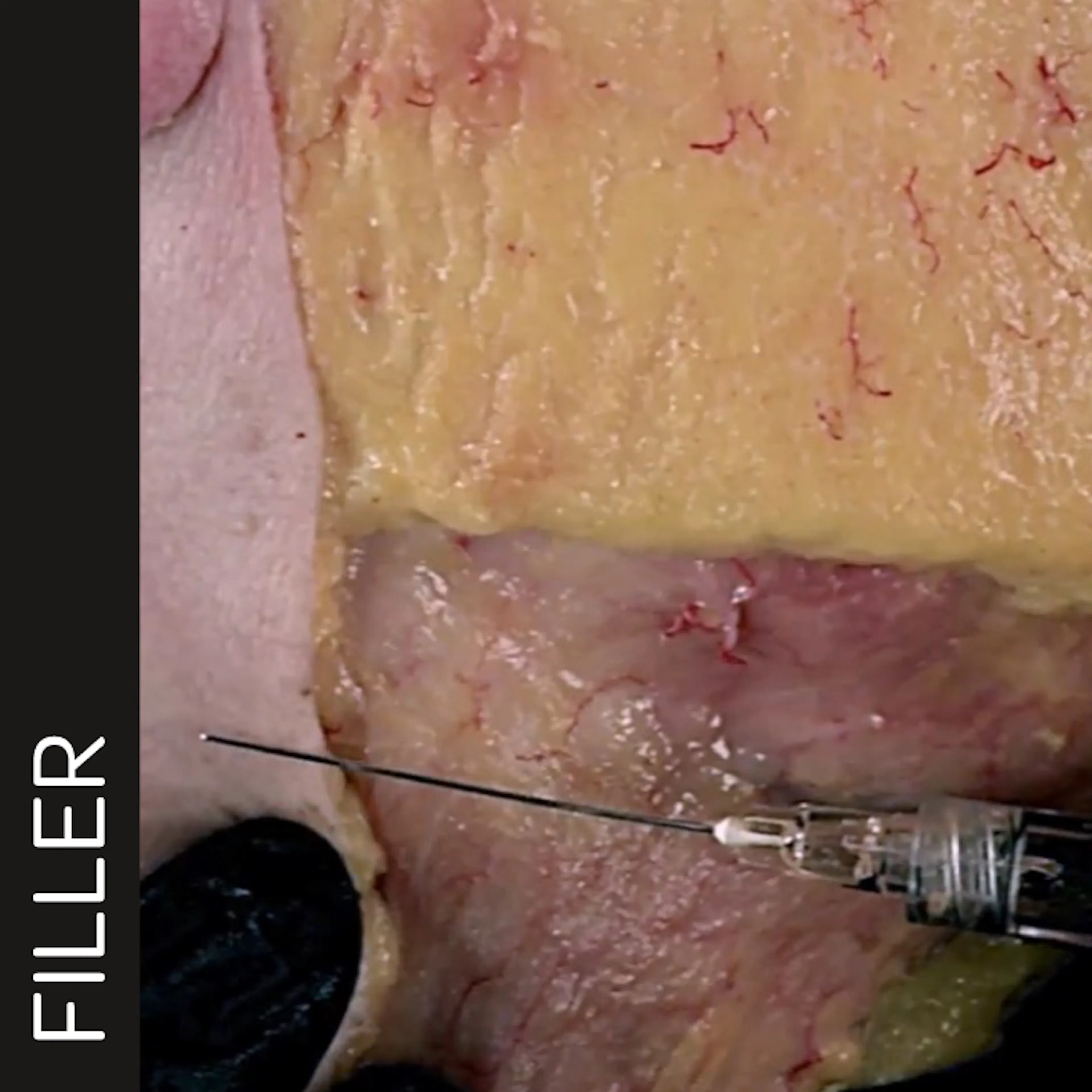 Horizontal Neck Lines Subdermal Cannula Technique