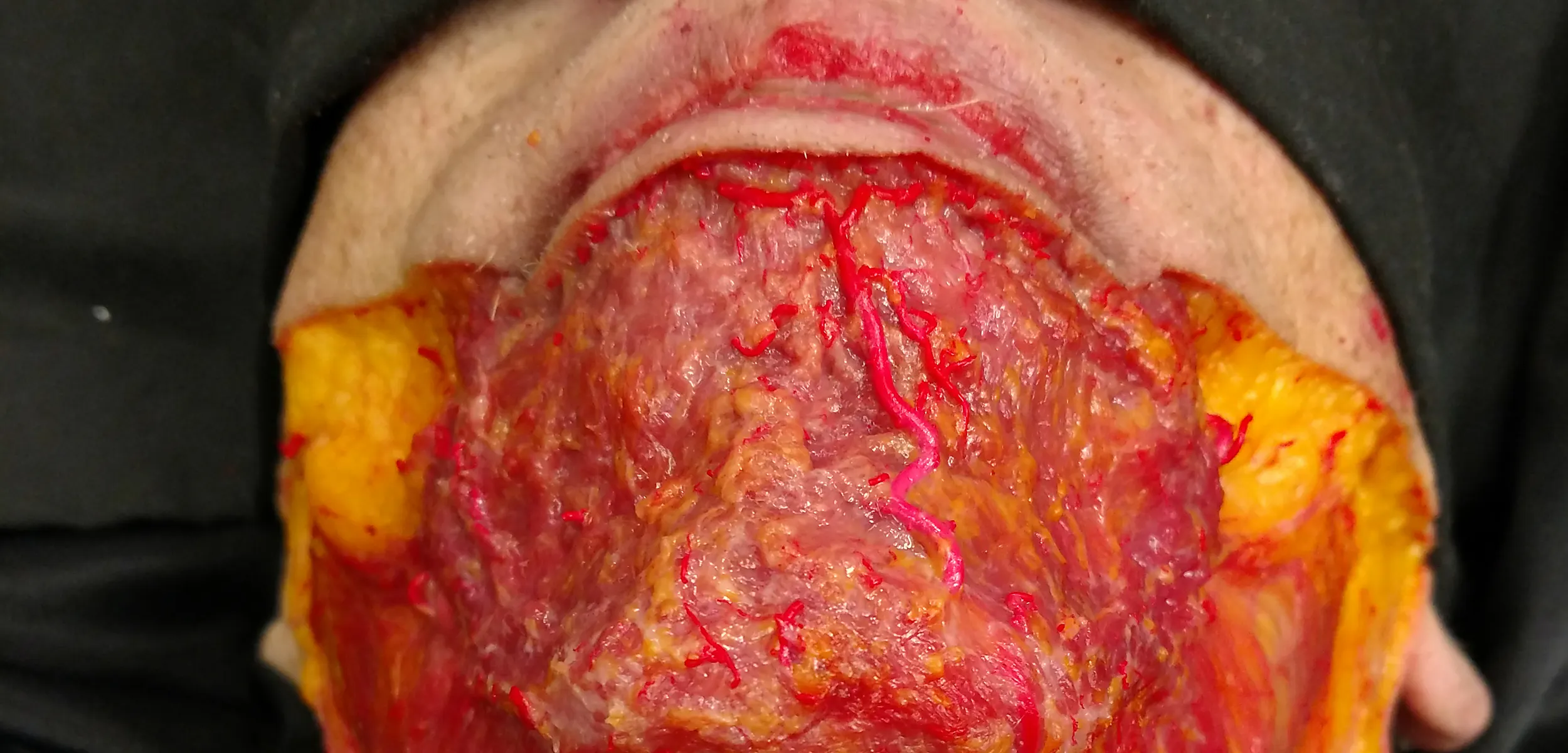 Horizontal Neck Lines Subdermal Cannula Technique