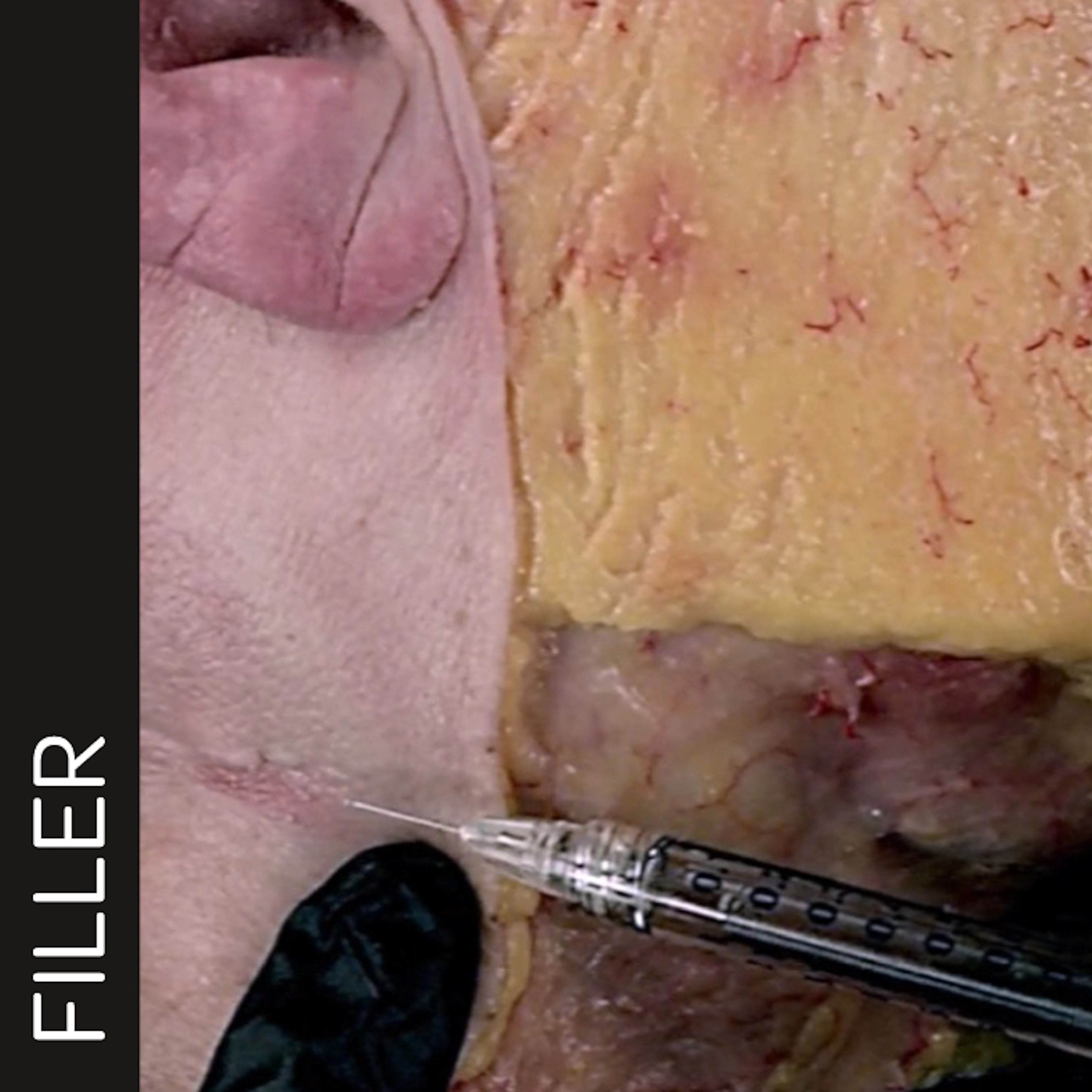 Horizontal Neck Lines Intradermal Needle Technique
