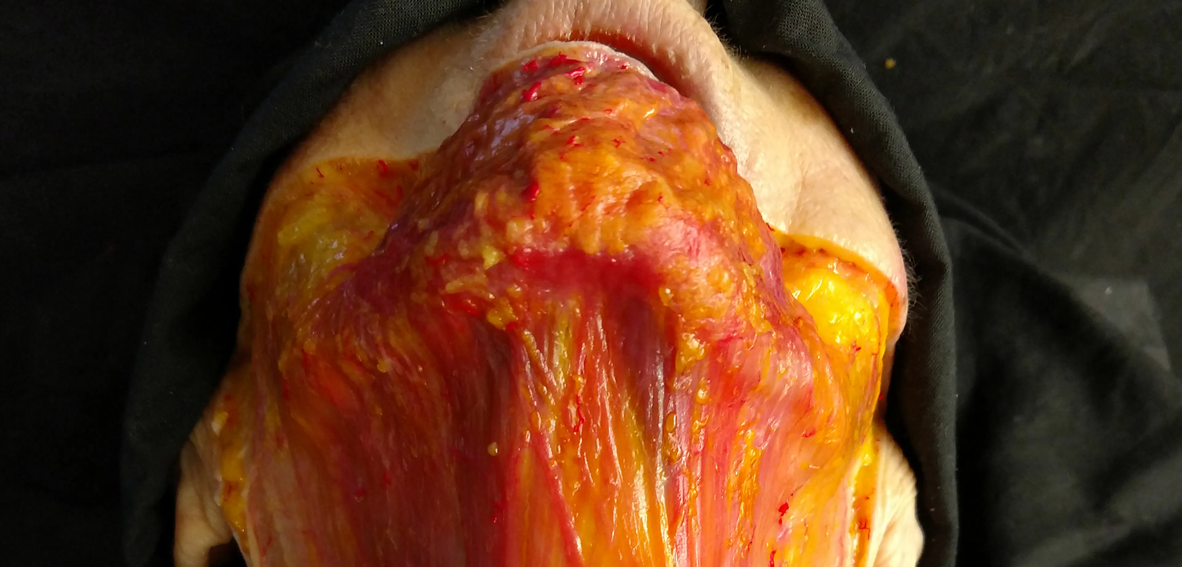 Horizontal Neck Lines Intradermal Needle Technique
