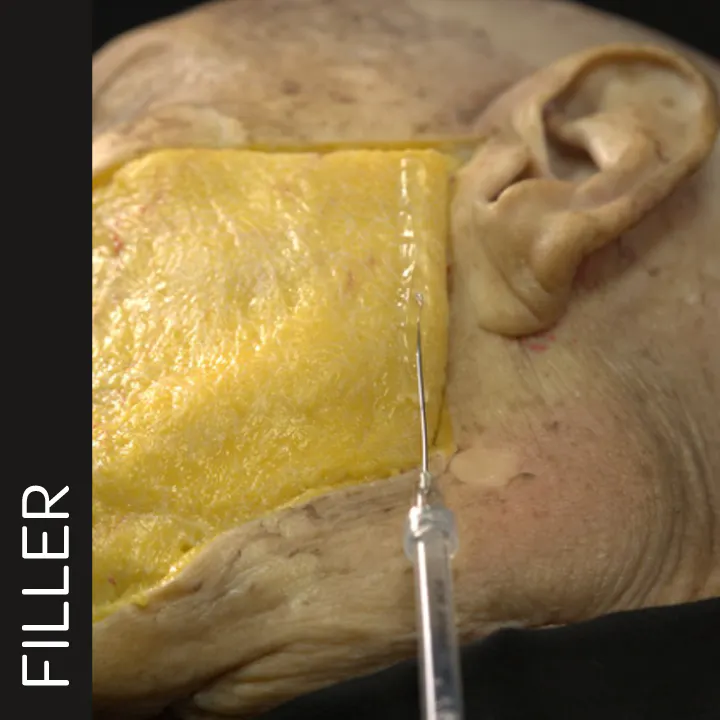 Jawline Contouring with Cannula: Angle Access