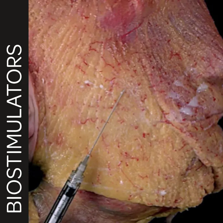 Biostimulator Treatments of the Lateral Face: The Star Technique