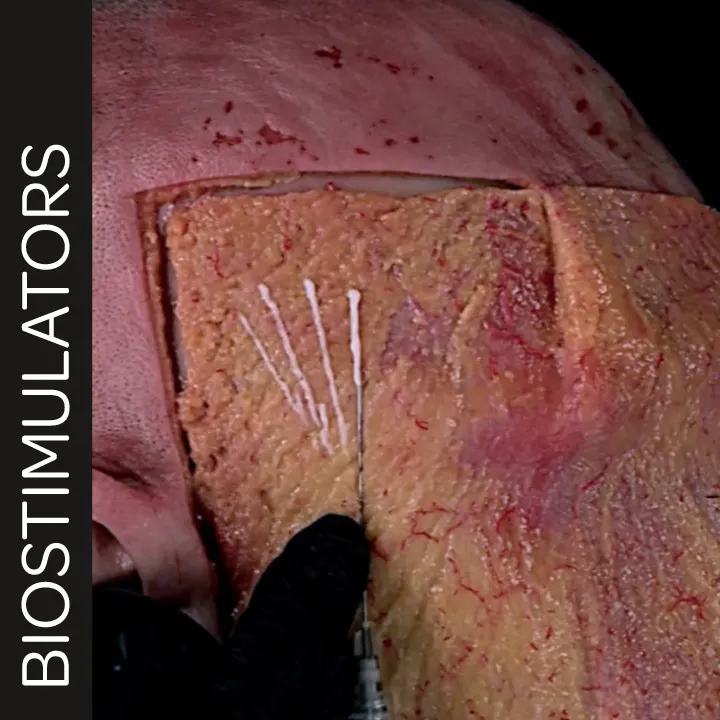 Biostimulator Treatments of the Temple: Superficial Cannula Technique