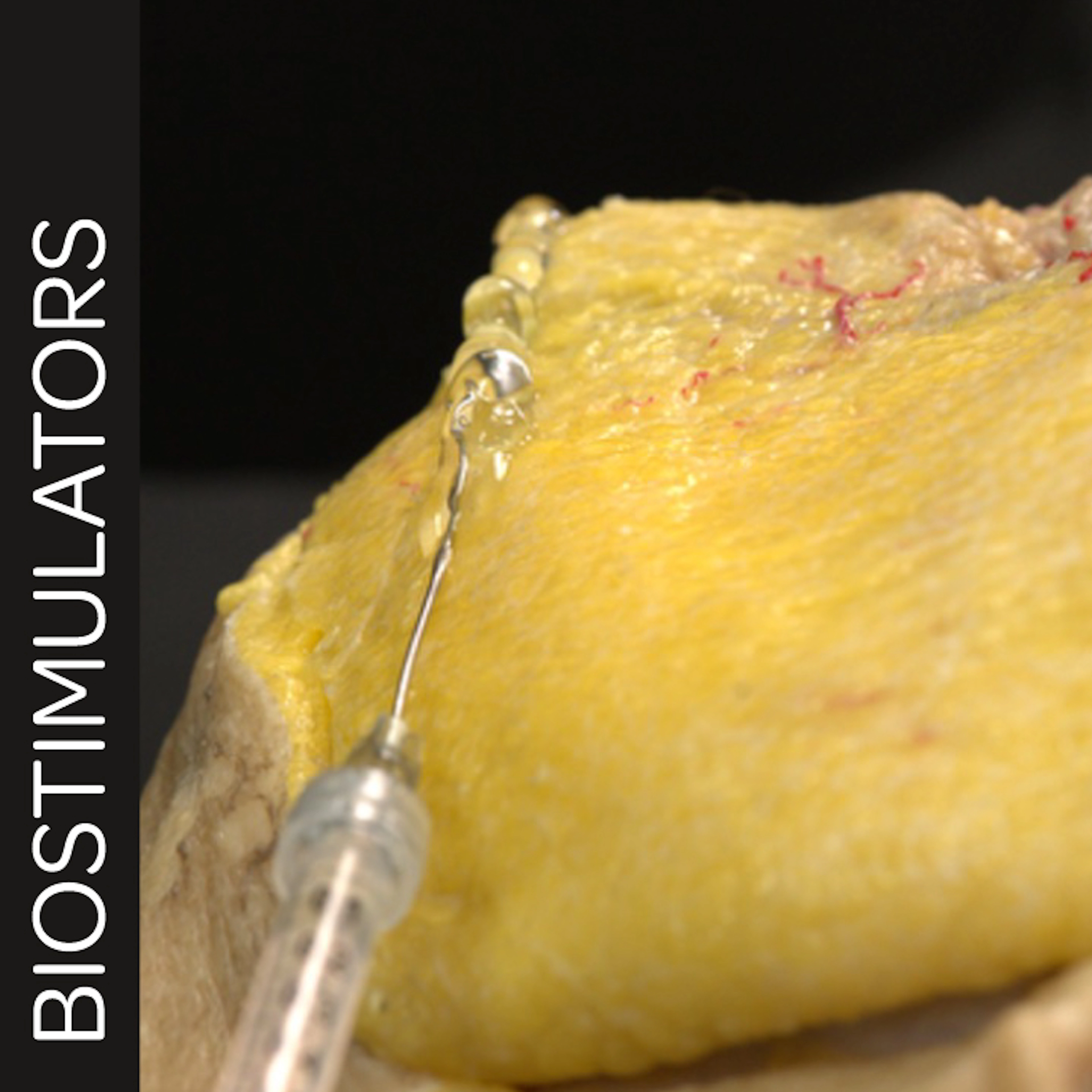 Biostimulator Treatments of the Jawline: Superficial Cannula Technique